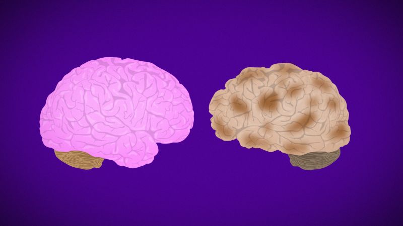 Alzheimer's Disease Fast Facts | CNN